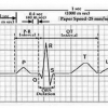 شبیه سازی و تولید سیگنال ECG با متلب
