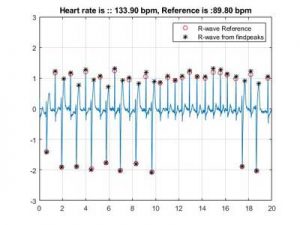 استخراج ویژگی سیگنال ECG قلب در متلب