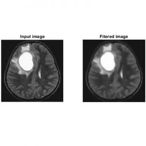 تشخیص و طبقه بندی تومور مغزی در تصاویر MRI در متلب
