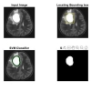 تشخیص و طبقه بندی تومور مغزی در تصاویر MRI در متلب